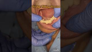 Teeth Capping Process trending shorts viral dr teeth doctor ashortaday dental ytshorts [upl. by Kleiman901]