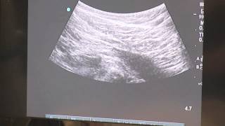 Trigger Point Injections  Ultrasound Guided [upl. by Strander952]