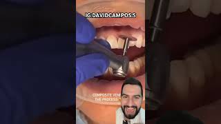 CARILLAS PARA LOS DIENTES SIN DESGASTAR [upl. by Solomon]