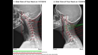 How To Correct Forward Head Posture and Cervical Lordosis With The Cervical Vibratory Traction [upl. by Tlaw]