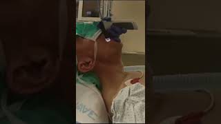 Medical Intubation Fixed Flexed Neck is a non issue when using the VS with the paraglossal technique [upl. by Osrit]