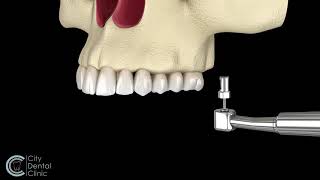 Sinus Lift  surgery before dental implant placement [upl. by Anelac]