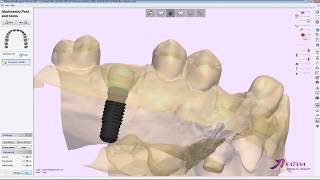 Screw Retained Crown Design Workflow in 3shape Part1 [upl. by Fernandes]