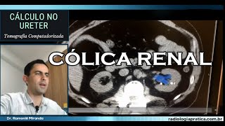 CÁLCULO RENAL Avaliação por Tomografia Computadorizada cálculorenal nefrolitíase [upl. by Eeslehc]