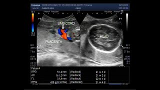 Ultrasound Video showing extreme of Oligohydromnios is Anhydramnios [upl. by Phyl]