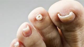 How Excilor Fungal Nail Treatment works  Now in UK [upl. by Karole]