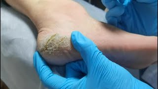 Pedicure  Wow Look at cracked heels Dead skin removal and Cracked heels treatment [upl. by Leak]