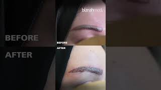 Eyebrow Hair Transplant  Eyebrow Transplant Results  Women Hair Transplant Before amp After [upl. by Nnel]