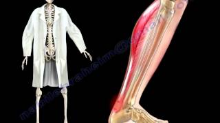 Achilles Tendon Stress amp Strain  Everything You Need To Know  Dr Nabil Ebraheim [upl. by Poppo]