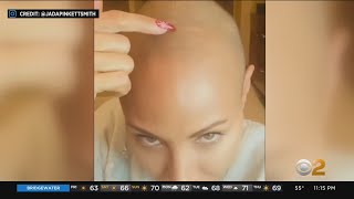 Doctors report uptick in alopecia patients coming forward for help [upl. by Nelleus113]