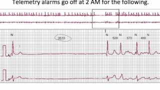 Talk regarding Atrial Fibrillation Bradycardia or pause Asymptomatic [upl. by Hillari]