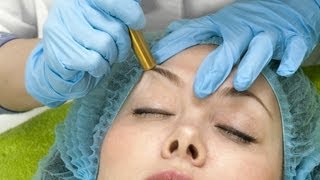 Microdermabrasion amp Acne Scars  Acne Treatment [upl. by Drofkcor]