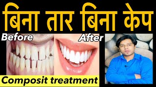 how to close space between teeth  gap in teeth fixed without braces  composit treatment [upl. by Waxler60]