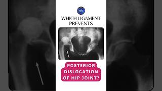 Which ligament prevents the posterior dislocation of hip joint shorts hipjoint ligaments [upl. by Leiva]