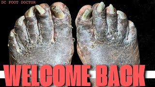 Welcome Back  Fungal Toenails and Severe Fungal Dermatitis [upl. by Einatsed468]