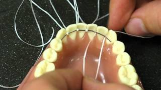 Bonded Retainer following orthodontics treatment [upl. by Maddie]