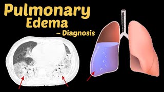 Pulmonary Edema diagnosis CT Scan Chest  Radiology [upl. by Mallorie]