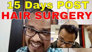 hair transplant 15 days Post FUE Hair Transplant [upl. by Stavro423]