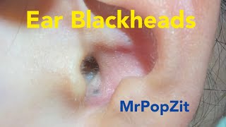 Ear Blackhead extractionsDeep in the ear blackheadsQuick extractions one dry one juicy MrPopZit [upl. by Yc]