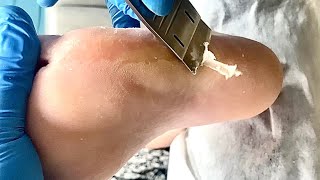 Callus removal from feetampFoot scraping dead skin【Xiao Yan pedicure】stress 16 [upl. by Waterer]