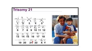 Chromosomal abnormalities Video No 498 [upl. by Kirch]