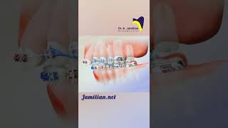 Upper Jaw Retraction Using First Molar Extraction bracs dentist orthodontics smile extraction [upl. by Woodrow]