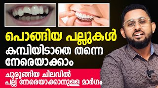 പൊങ്ങിയ പല്ലുകൾ കമ്പിയിടാതെ തന്നെ നേരെയാക്കാം  Clear Aligners Malayalam  Dr Varun Nambiar [upl. by Davida]