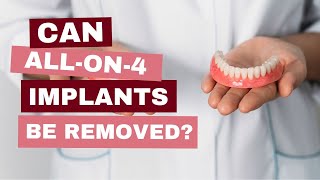 Can AllOn4 Implants Be Removed [upl. by Frazier]