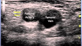 Femoral Nerve Sonoanatomy  QMH AED Ultrasound Casebook 2013 Video 12 [upl. by Naryk]