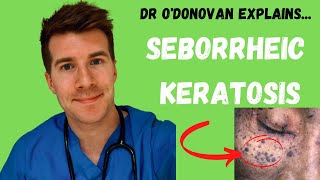 Explaining Seborrheic Keratosis  With Dr ODonovan [upl. by Boyse]