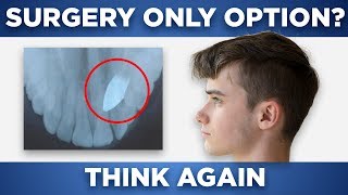 Avoided Surgery With Orthotropics Stan’s Story [upl. by Giarg]