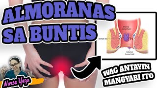 HEMORRHOIDS O ALMORANAS SA BUNTIS  LUNAS SA HEMORRHOIDS [upl. by Adlog]