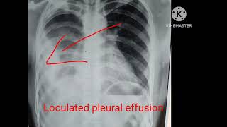 Loculated pleural effusion [upl. by Onihc]