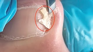 【Daily Pedicure Tutorial】Trimming Out The Massive Ingrown Nails From The Flat Nails [upl. by Eniotna]