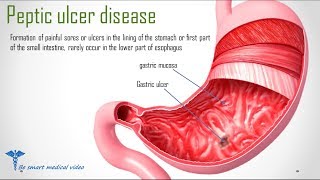 Quick review Peptic Ulcer Disease  Causes treatment [upl. by Narat]