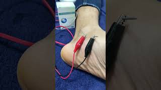 Dry needling  Tendinite de jambier posterieur douleur au pied [upl. by Veats]