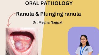 Ranula  Oral Pathology  Understand in 5 Mins [upl. by Ydeh536]