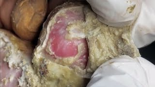 Pedicure video26，vertical plantaris，plantar wart [upl. by Annaeiluj]