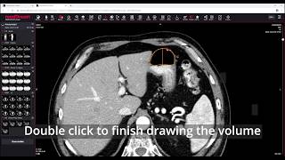 MedDream DICOM Viewer measure the volume [upl. by Aniluap]