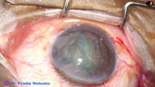 Use of Prechopper in a cataract with 5 clock hours of Zonular Defect Pradip Mohanta 29July 2024 [upl. by Kore]