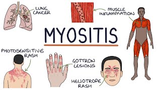 Understanding Myositis Polymyositis and Dermatomyositis [upl. by Oiliduab]