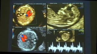 Ecocardiografía del I trimestre  Prof Ignacio Montaño [upl. by Nwahsud]