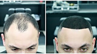 FIXED BALDING USING HAIR FIBERS [upl. by Nohsram]