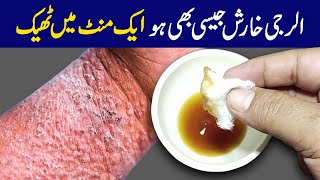 100٪Effective Remedy for Itching amp Prickly Heat  خارش ایک منٹ میں ٹھیک  Khaj Khujli ka ilaj [upl. by Hyacinthe989]