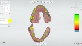 TRIOS 3shape occlusion settings flag adjust for contacts [upl. by Tyrrell]