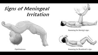 Meningeal signs in Neurological examination Brudzunski Kernigs Nuchal rigidity Opisthotonos [upl. by Gnos]