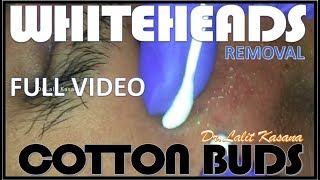 WHITEHEADS REMOVAL WITH COTTON BUDS FULL VIDEO [upl. by Isteb]