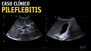 Caso clínico 109 Pileflebitis  Tromboflebitis venosa portal supurativa [upl. by Vanni]