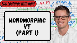 Monomorphic Ventricular Tachycardia  Day 21 ECG Challenge [upl. by Airetal]