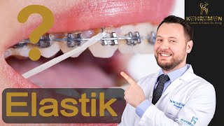 Ortodontik Lastikler Nasıl Takılır Sınıf II Elastik Kullanımı [upl. by Ayital]